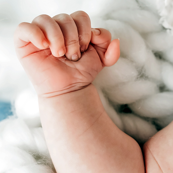 A close-up of a baby's hand with polydactyly