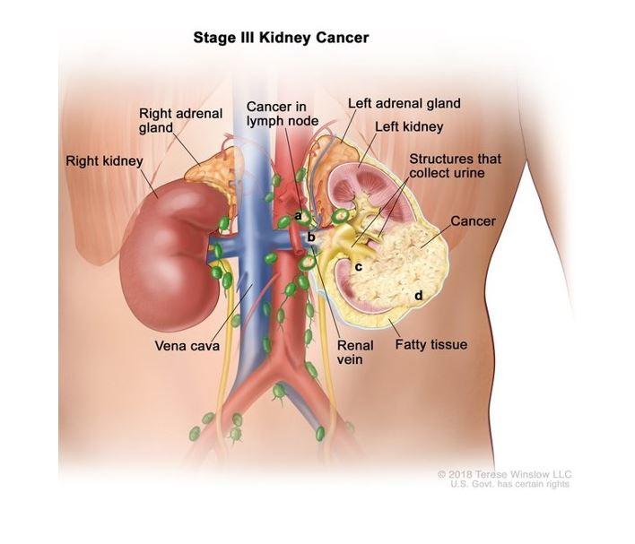 Anatomic illustration of stage 3 kidney cancer