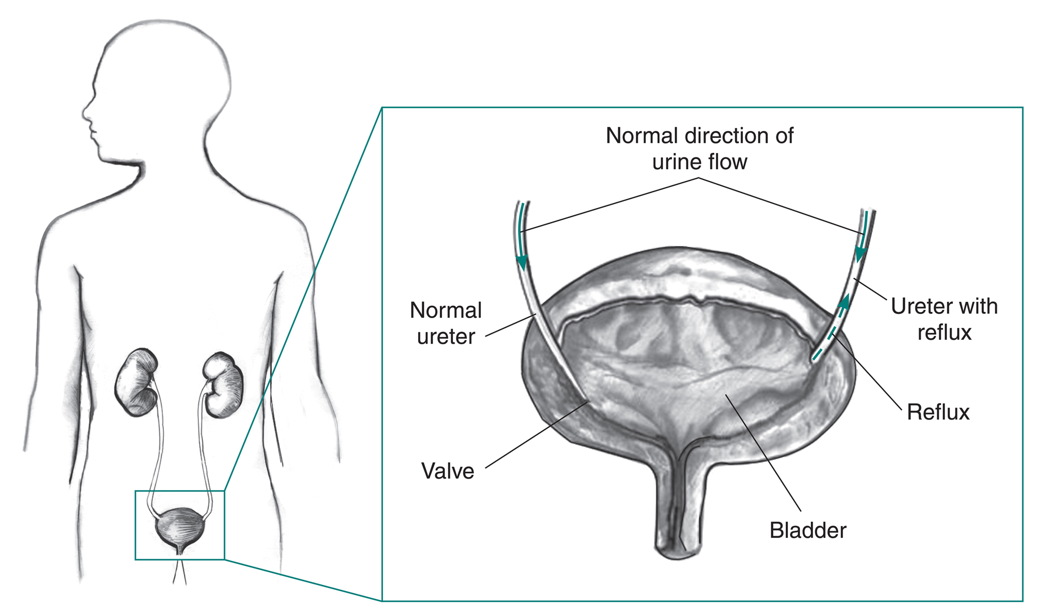 Drug pair cuts children’s urinary infections up to 80 percent ...