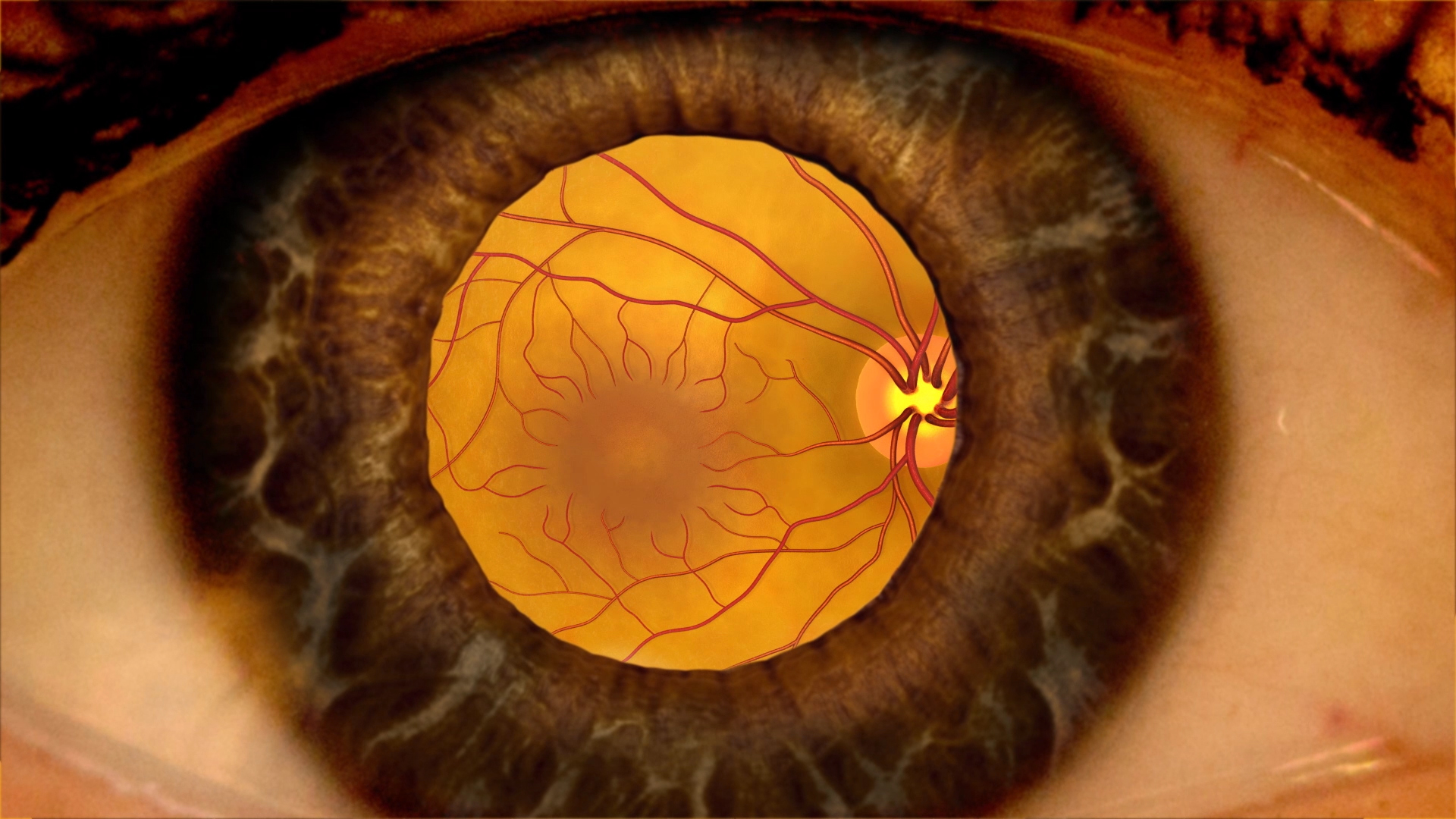 eylea-outperforms-other-drugs-for-diabetic-macular-edema-with-moderate