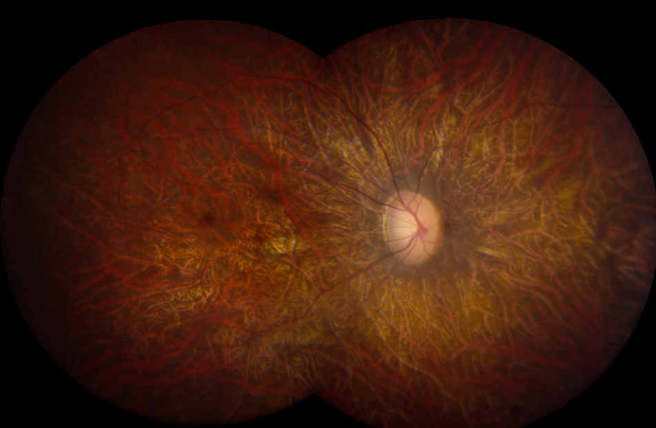 define retinitis