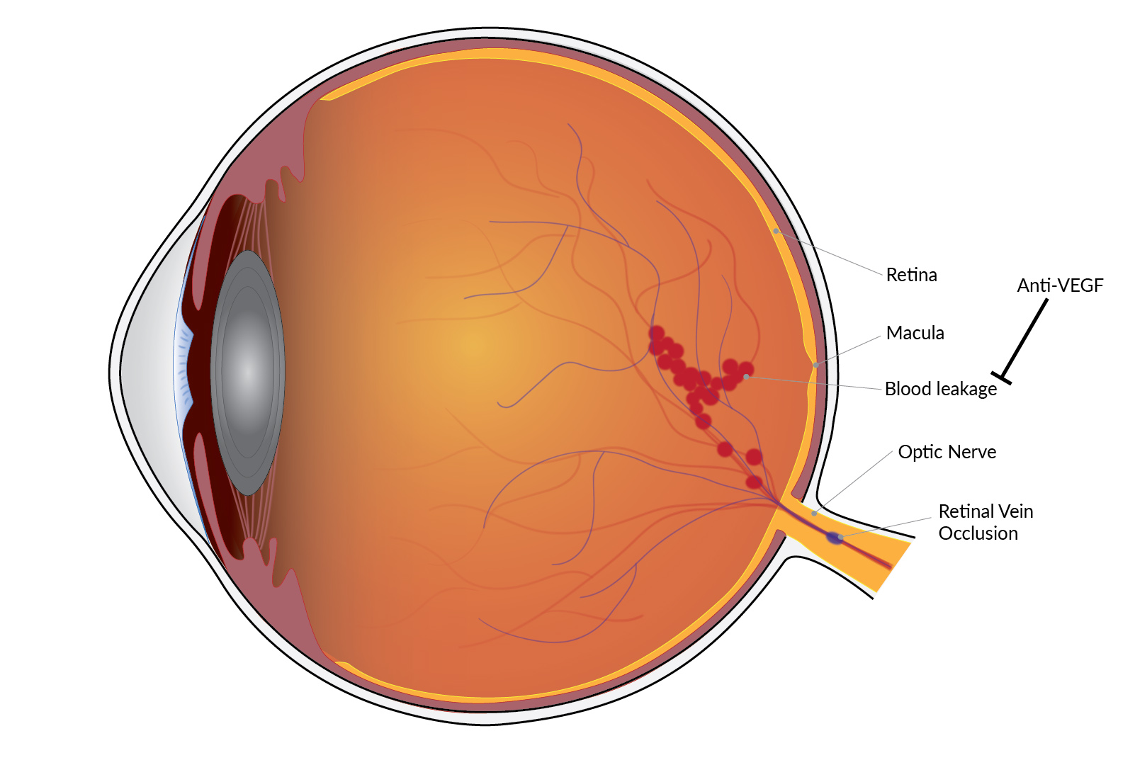 Vision improvement is long-lasting with treatment for blinding