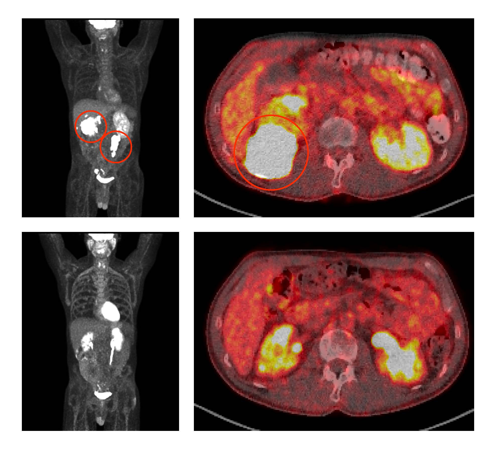 Image of medical scans that show shrinking tumors in a patient with large lymphoma tumors.