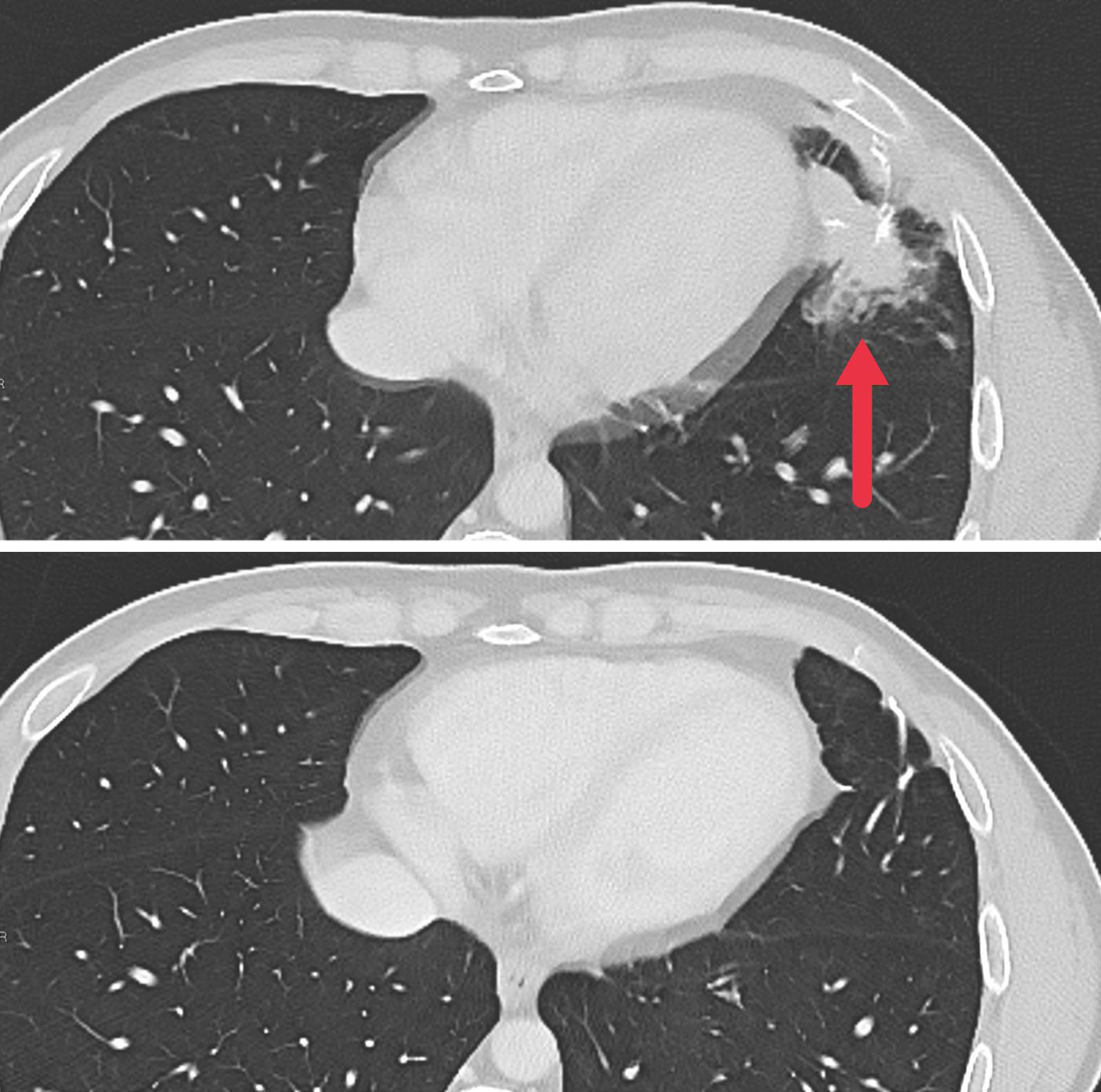 CT scan showing tumor before and after treatment.