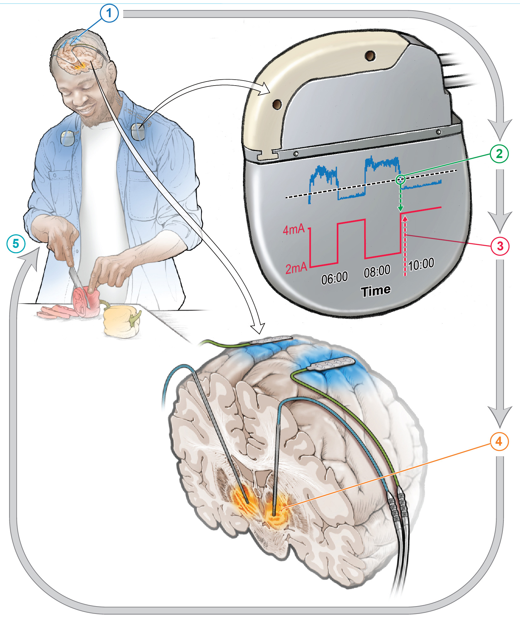 Drawing of a patient with a deep brain stimulation device as they prepare food in the kitchen