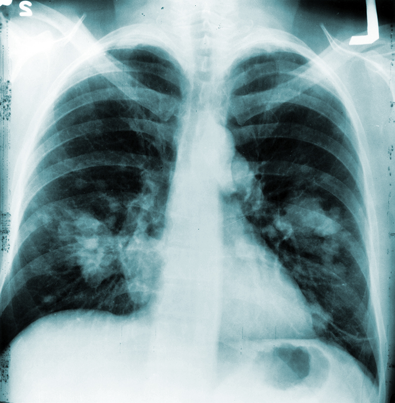 Annual Chest X-rays Don’t Cut Lung Cancer Deaths | National Institutes