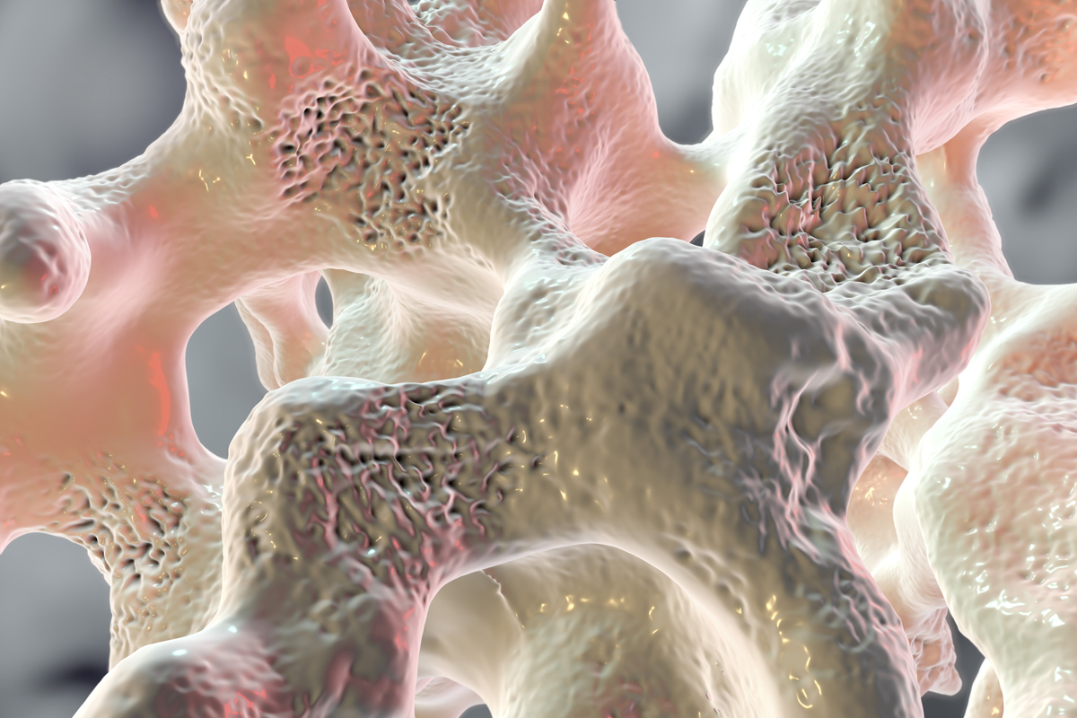 Genes Linked To Abnormal Bone Density And Fracture National 