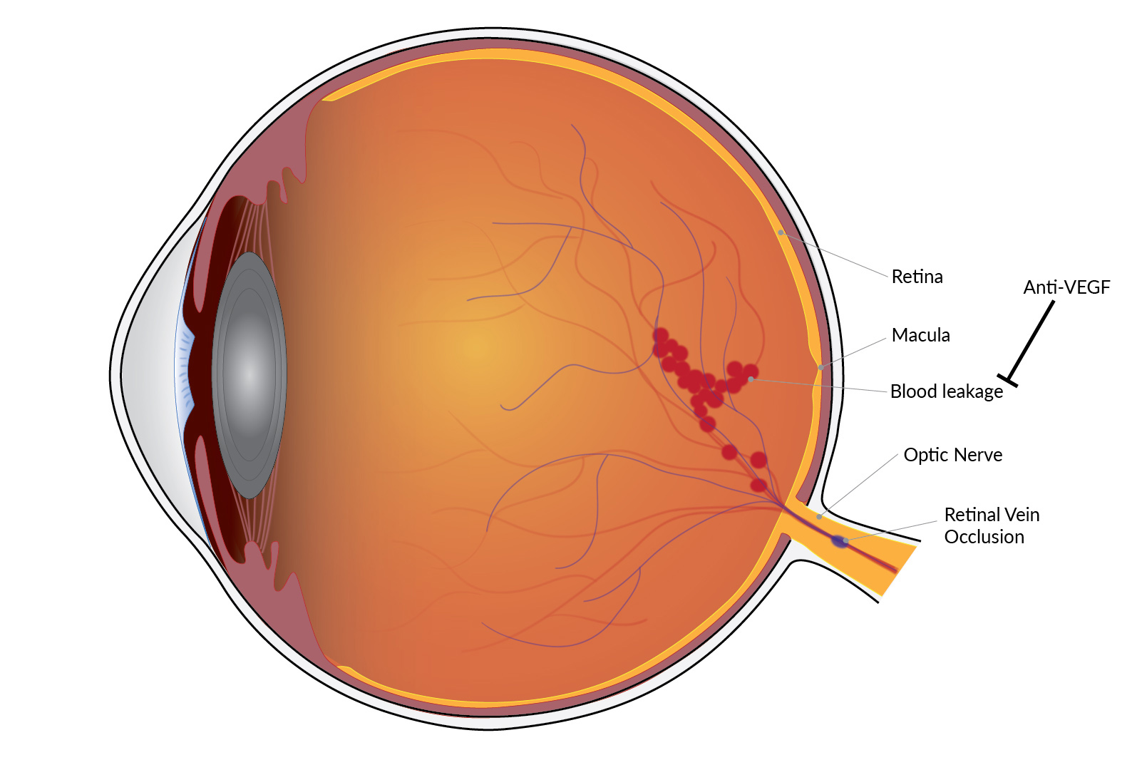 Treatment For Macular Edema Has Long lasting Gains National 