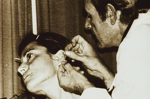 A physician is inserting needles into a woman's ear; other needles have been placed at various points on her face