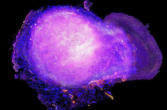 Transparent tumor tomograph image of numerous immune cells around a larger tumor.