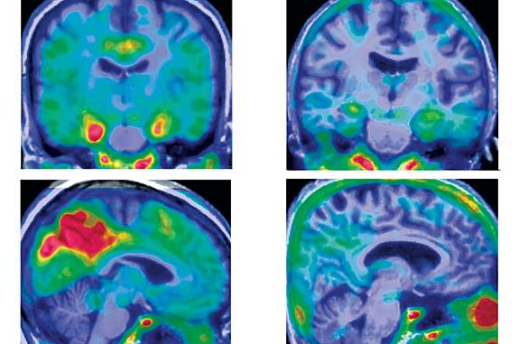 Four tau PET brain images show larger areas of red in left two images
