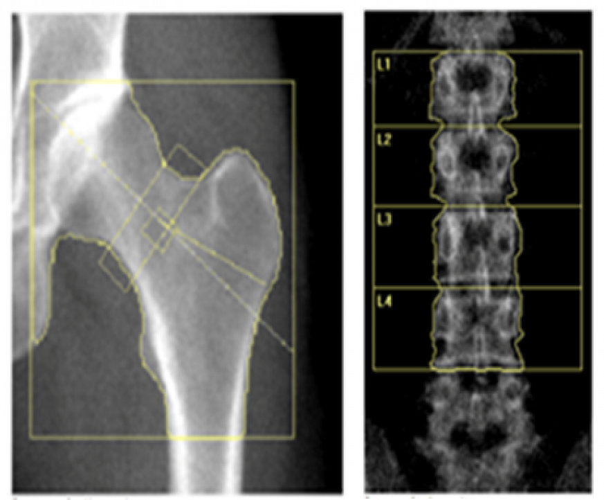 Bone Density Scan Results / Bone Densitometry - The More Bone Material ...