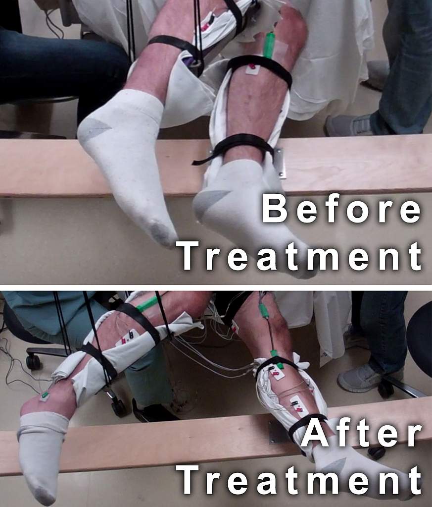 Paralyzed Men Move Legs With New Non-invasive Spinal Cord Stimulation ...