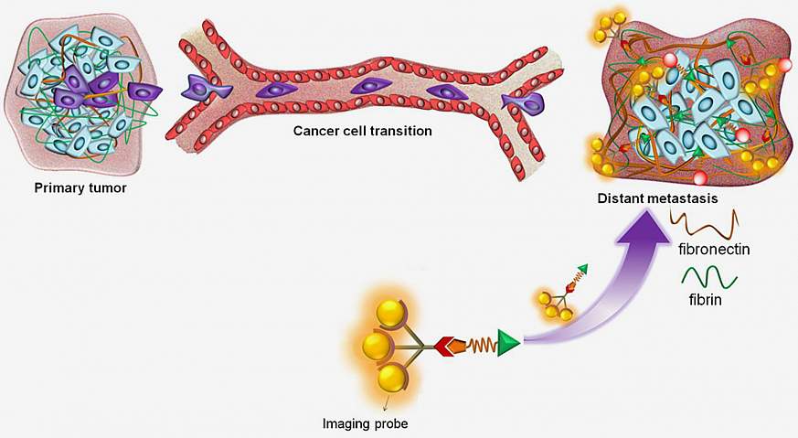 Tell-tale Biomarker Detects Early Breast Cancer In NIH-funded Study ...