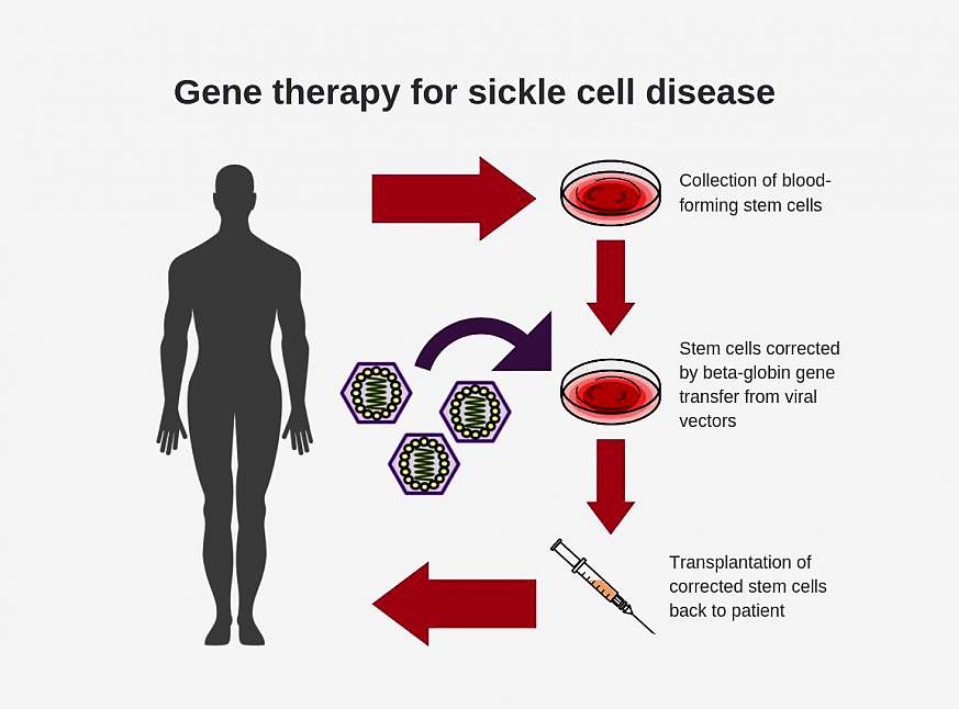 : Diagram shows steps for conducting gene therapy for sickle cell disease: Blood-forming stem cells are collected, stem cells are corrected by beta-globin gene transfer from viral vectors, and then corrected stem cells are transplanted into patient.
