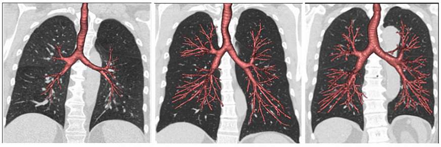 Smoking and Chronic Lung Disease: What To Know
