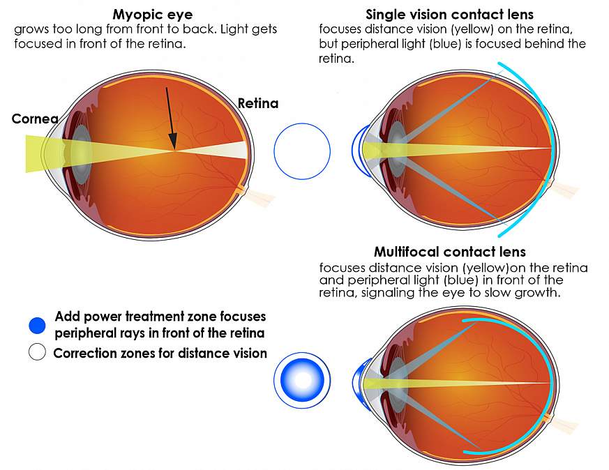 Illustration describing multifocal contact lenses