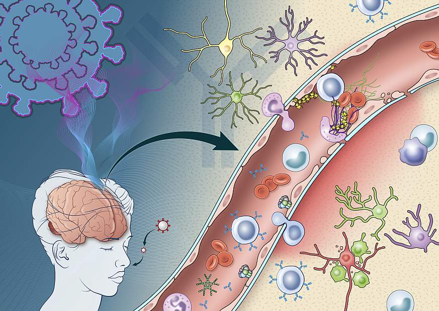 Small NIH Study Reveals How Immune Response Triggered By COVID-19 May Damage The Brain ...