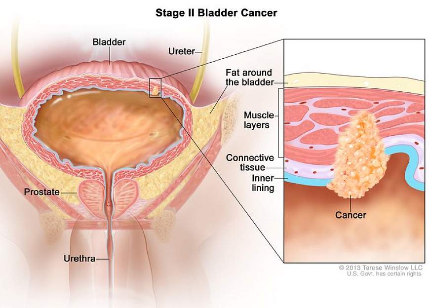 Medical illustration of stage 2 bladder cancer