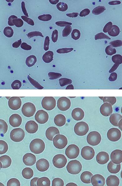 Bone Marrow Transplant For Sickle Cell Anemia