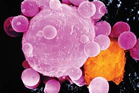 癌细胞死亡。淋巴细胞攻击癌细胞的彩色扫描电镜。