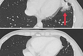 CT scan showing tumor before and after treatment.