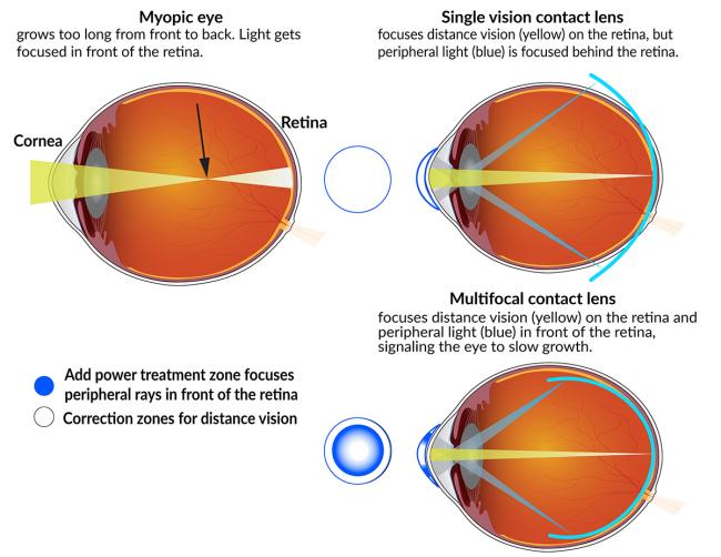 20250218-nei-lense Myopic eyes grow too long from front to back, so light gets focused in front of the retina. Single-vision contact lenses focus distance vision on the retina, but peripheral light behind it. Multifocal lenses focus peripheral light in front, slowing growth