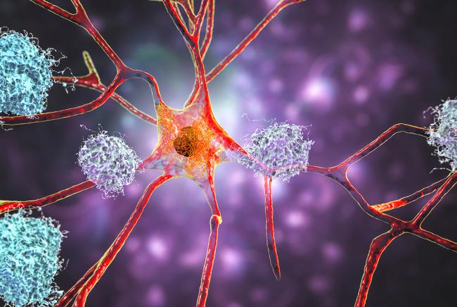 Neurons in Alzheimer's disease. Illustration showing amyloid plaques in brain tissue