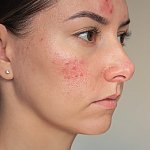 A close-up of a woman with rosacea on her cheek and forehead