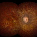 Photo of a retina